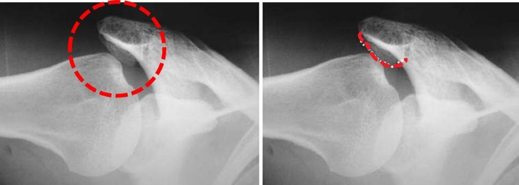 어깨 골극 Xray