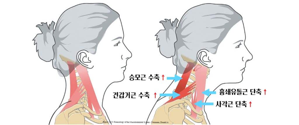 거북목의 근육