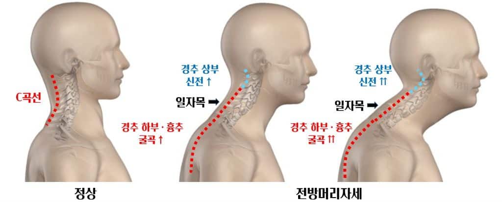 거북목척추정렬