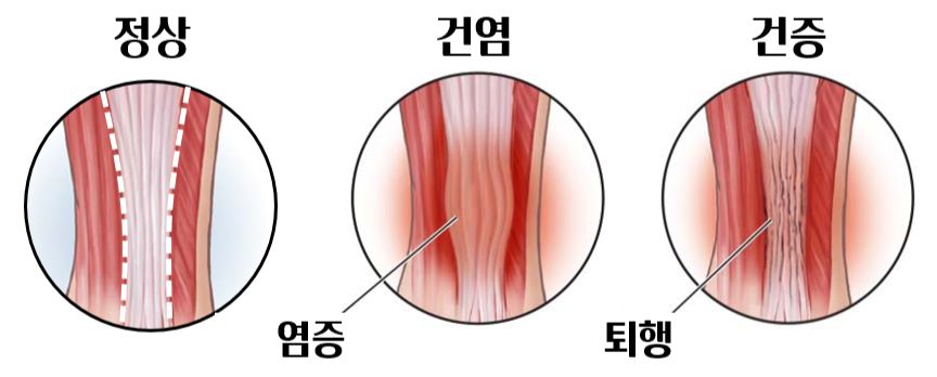 건염 건증