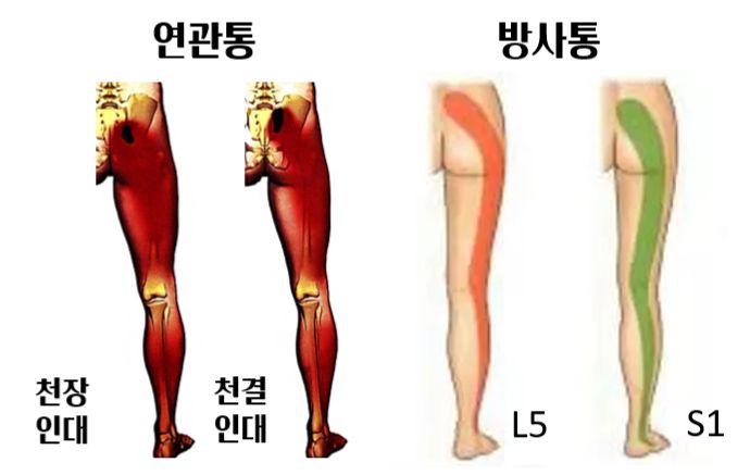 연관통 방사통