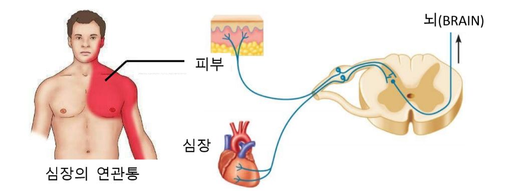 프롤로치료 연관통