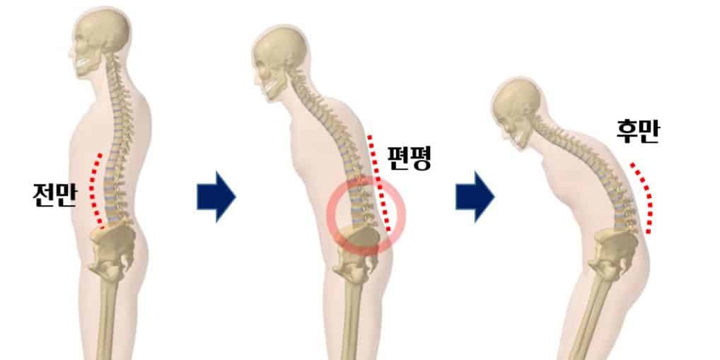 요추후만