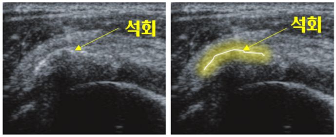 석회성건염초음파